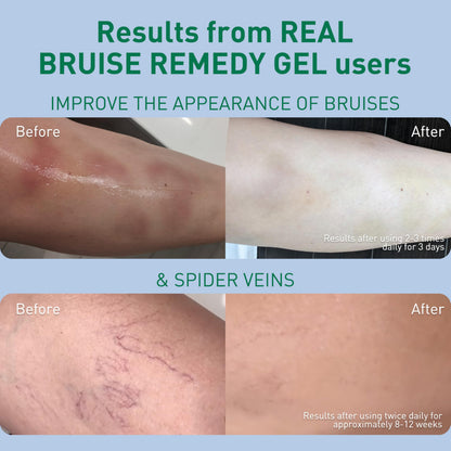 PROcure Arnica & MSM Bruise Remedy Gel – Paraben-Free, Unscented Arnica Montana Gel for Bruising, Spider Veins & Skin Discoloration – 2 Pack PROcureBuy Supplements Australia